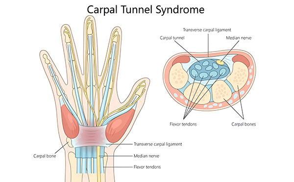 Understanding Carpal Tunnel Syndrome: Symptoms, Causes & When to See an Orthopedic Doctor Near You